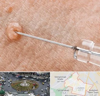 لیزر زگیل تناسلی در فردیس کرج 