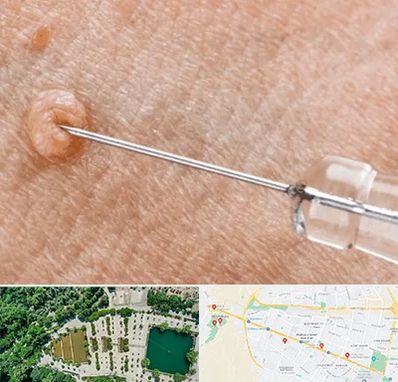 لیزر زگیل تناسلی در وکیل آباد مشهد 