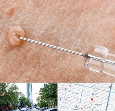 لیزر زگیل تناسلی در امامت مشهد 