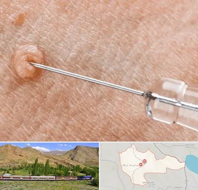 لیزر زگیل تناسلی در خاش