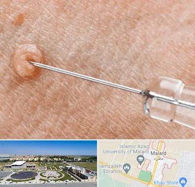 لیزر زگیل تناسلی در ملارد