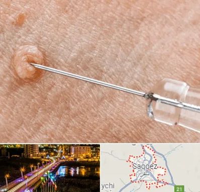 لیزر زگیل تناسلی در سقز