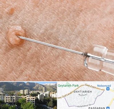 لیزر زگیل تناسلی در اختیاریه 