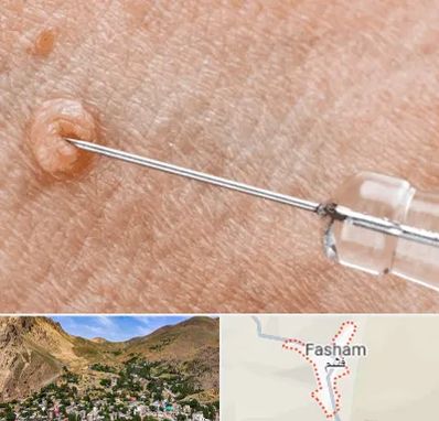 لیزر زگیل تناسلی در فشم