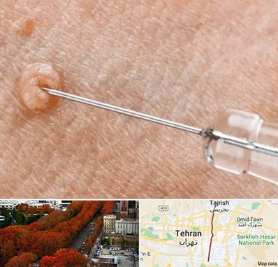 لیزر زگیل تناسلی در ولیعصر 