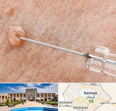 لیزر زگیل تناسلی در کرمان