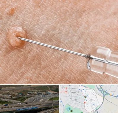 لیزر زگیل تناسلی در یاغچیان تبریز