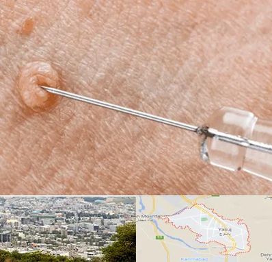 لیزر زگیل تناسلی در یاسوج