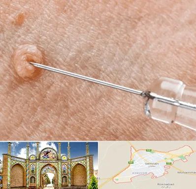 لیزر زگیل تناسلی در سمنان