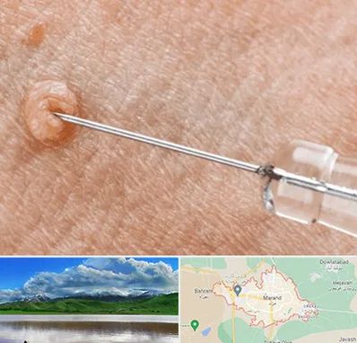 لیزر زگیل تناسلی در مرند