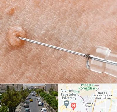 لیزر زگیل تناسلی در شهران 