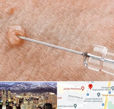 لیزر زگیل تناسلی در جردن 