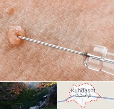 لیزر زگیل تناسلی در کوهدشت