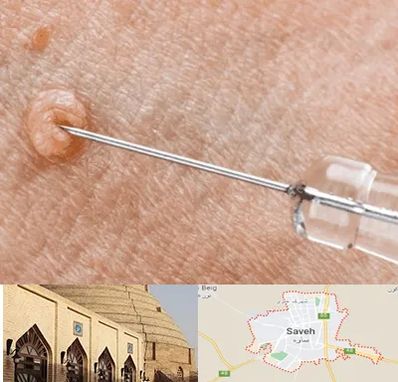 لیزر زگیل تناسلی در ساوه