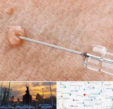 لیزر زگیل تناسلی در میدان حر 