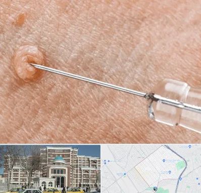 لیزر زگیل تناسلی در طلاب مشهد