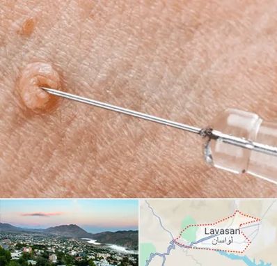 لیزر زگیل تناسلی در لواسان