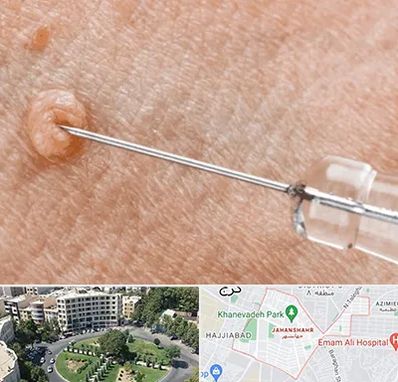 لیزر زگیل تناسلی در جهانشهر کرج 