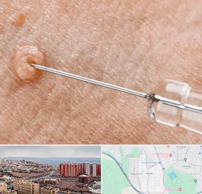 لیزر زگیل تناسلی در سهند تبریز