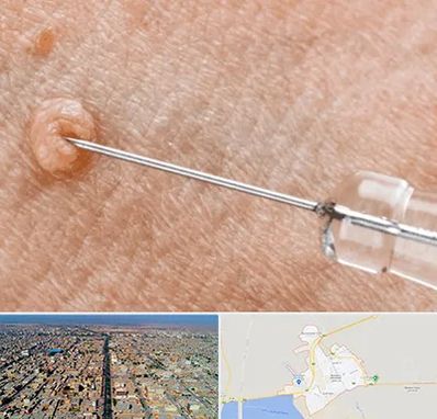 لیزر زگیل تناسلی در بندر ماهشهر