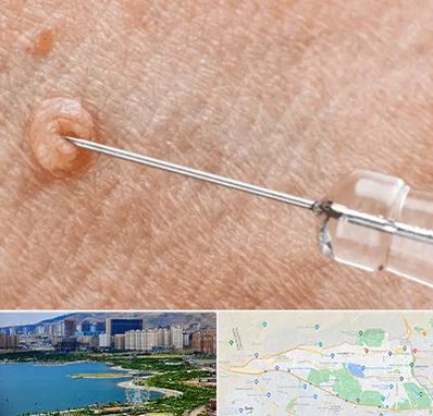 لیزر زگیل تناسلی در منطقه 22 تهران 