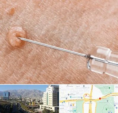 لیزر زگیل تناسلی در حقانی 