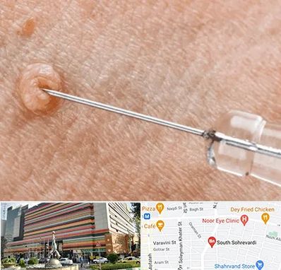 لیزر زگیل تناسلی در سهروردی 