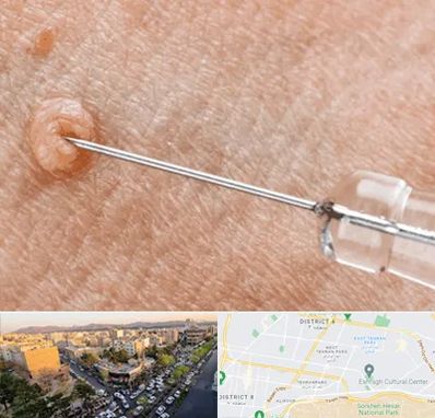 لیزر زگیل تناسلی در تهرانپارس 