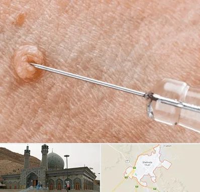 لیزر زگیل تناسلی در شهرضا