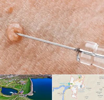 لیزر زگیل تناسلی در مهاباد