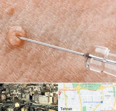 لیزر زگیل تناسلی در مرزداران 