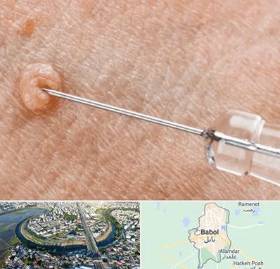 لیزر زگیل تناسلی در بابل