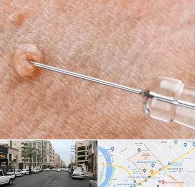 لیزر زگیل تناسلی در زیتون کارمندی اهواز 