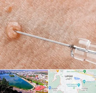 لیزر زگیل تناسلی در لاهیجان