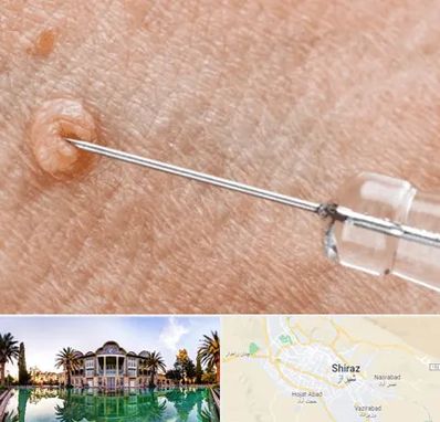 لیزر زگیل تناسلی در شیراز