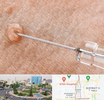 لیزر زگیل تناسلی در ونک 