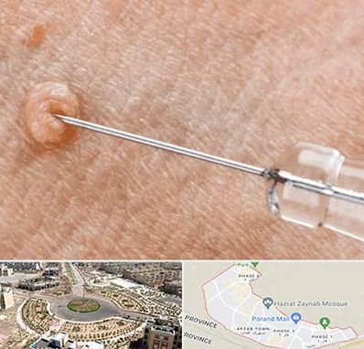 لیزر زگیل تناسلی در پرند