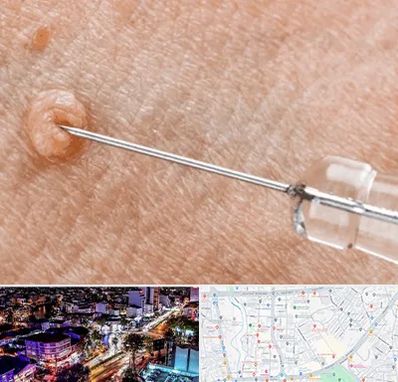 لیزر زگیل تناسلی در منظریه رشت 