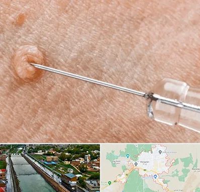 لیزر زگیل تناسلی در مراغه