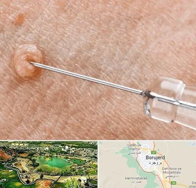 لیزر زگیل تناسلی در بروجرد