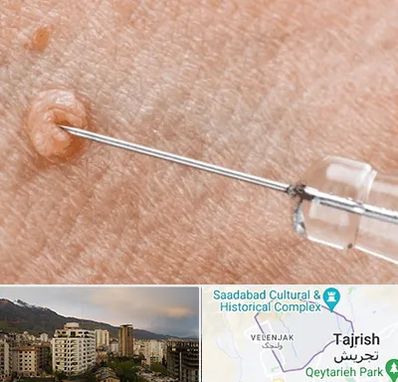 لیزر زگیل تناسلی در زعفرانیه 