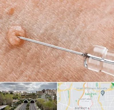 لیزر زگیل تناسلی در یوسف آباد 