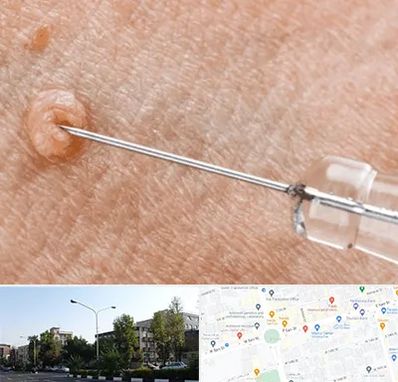 لیزر زگیل تناسلی در میدان کاج 