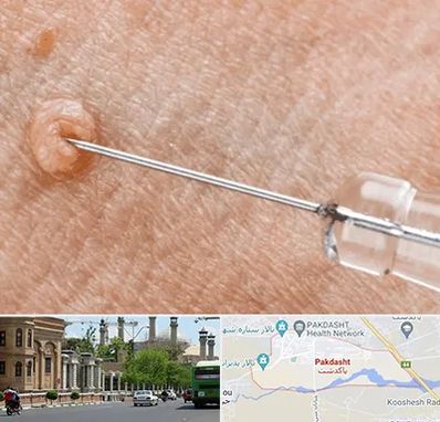 لیزر زگیل تناسلی در پاکدشت