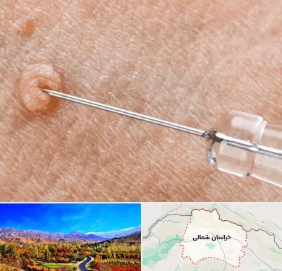 لیزر زگیل تناسلی در خراسان شمالی