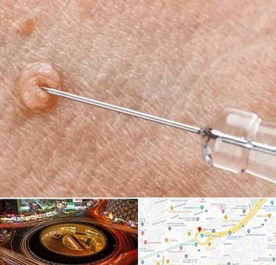 لیزر زگیل تناسلی در میدان ولیعصر 