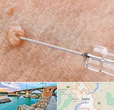 لیزر زگیل تناسلی در دزفول