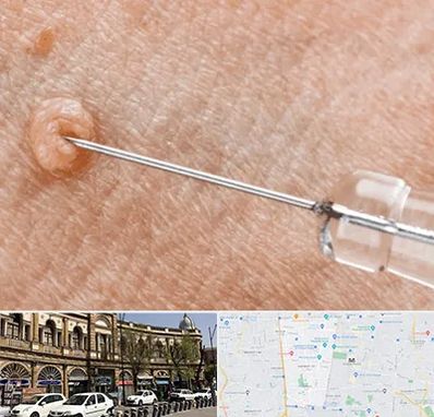 لیزر زگیل تناسلی در منطقه 11 تهران 