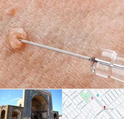 لیزر زگیل تناسلی در مصلی مشهد