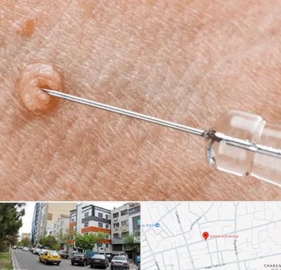 لیزر زگیل تناسلی در هفده شهریور تبریز